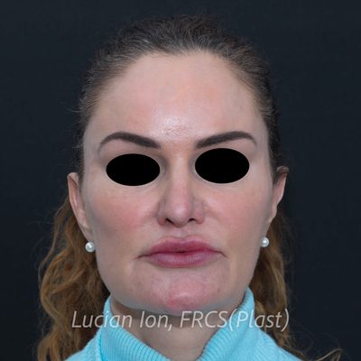 Before augmentation rhinoplasty, case 2, front view