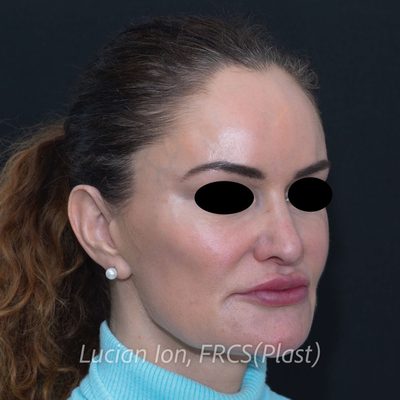 Before augmentation rhinoplasty, case 2, oblique view