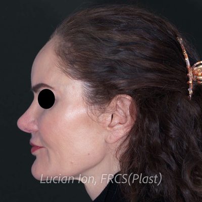 After augmentation rhinoplasty, case 2, profile view