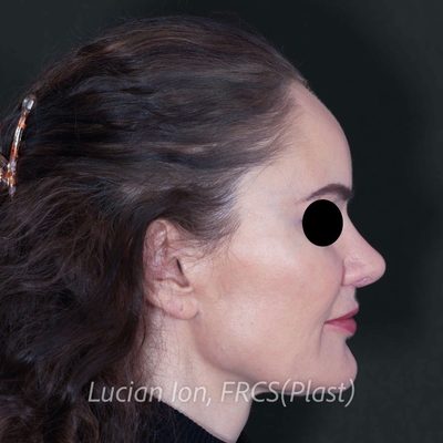 After augmentation rhinoplasty, case 2, profile view