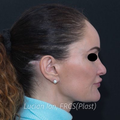 Before augmentation rhinoplasty, case 2, profile view