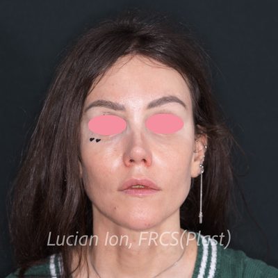 After augmentation rhinoplasty, case 3, front view