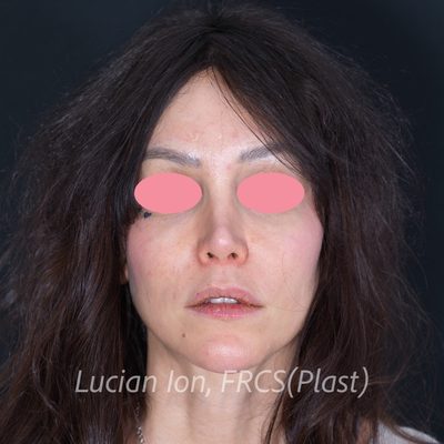Before augmentation rhinoplasty, case 3, front view