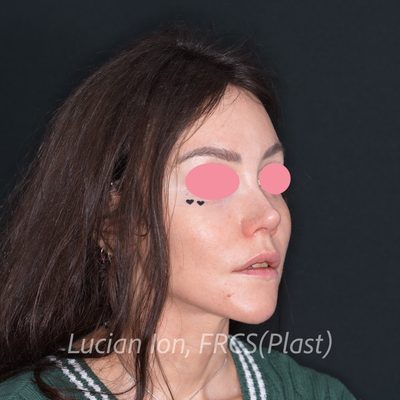 After augmentation rhinoplasty, case 3, oblique view