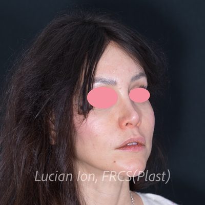 Before augmentation rhinoplasty, case 3, oblique view