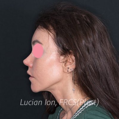After augmentation rhinoplasty, case 3, profile view