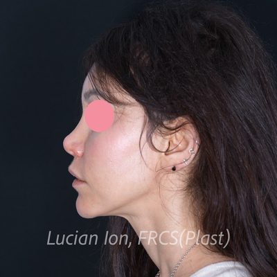 Before augmentation rhinoplasty, case 3, profile view