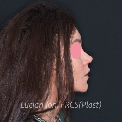 After augmentation rhinoplasty, case 3, profile view