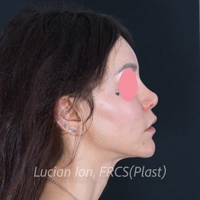 Before augmentation rhinoplasty, case 3, profile view