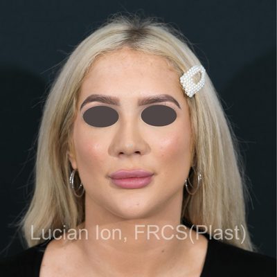 After deviated nose (crooked nose), case 1, front view