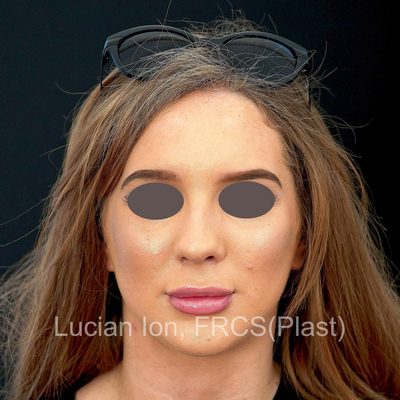 Before deviated nose (crooked nose), case 1, front view