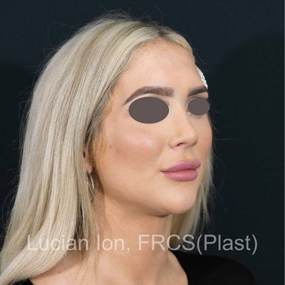 After deviated nose (crooked nose), case 1, oblique view