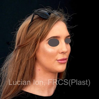 Before deviated nose (crooked nose), case 1, oblique view