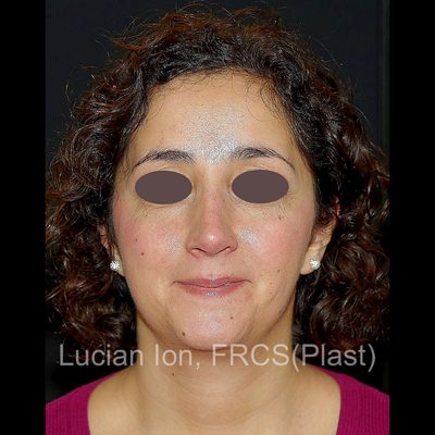 After deviated nose (crooked nose), case 2, front view