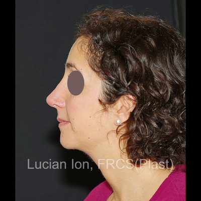 After deviated nose (crooked nose), case 2, profile view