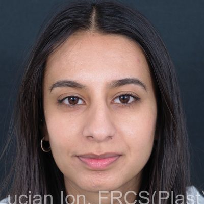 After deviated nose (crooked nose), case 3, front view