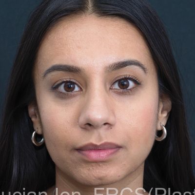 Before deviated nose (crooked nose), case 3, front view
