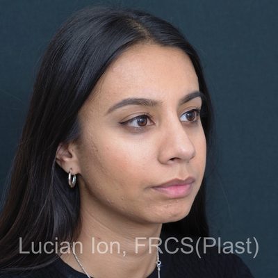 After deviated nose (crooked nose), case 3, oblique view