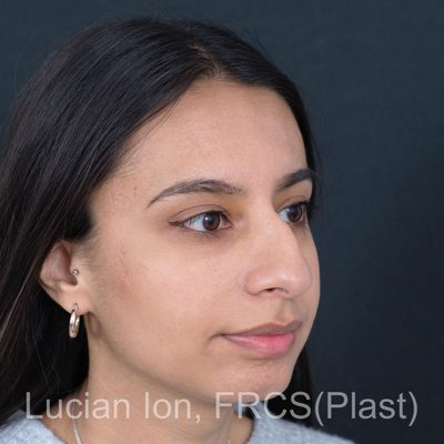 Before deviated nose (crooked nose), case 3, oblique view