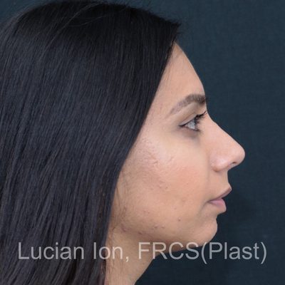 After deviated nose (crooked nose), case 3, profile view