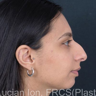 Before deviated nose (crooked nose), case 3, profile view