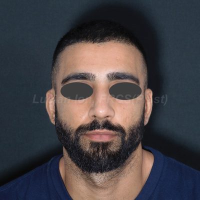 After deviated nose (crooked nose), case 4, front view