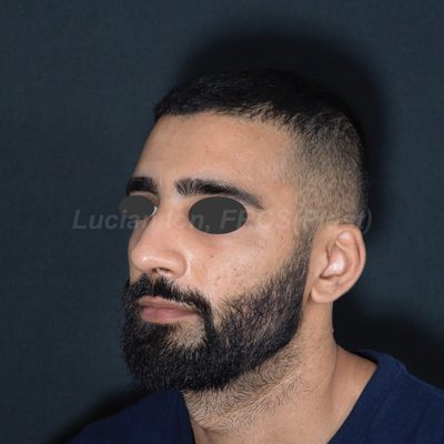 After deviated nose (crooked nose), case 4, oblique view