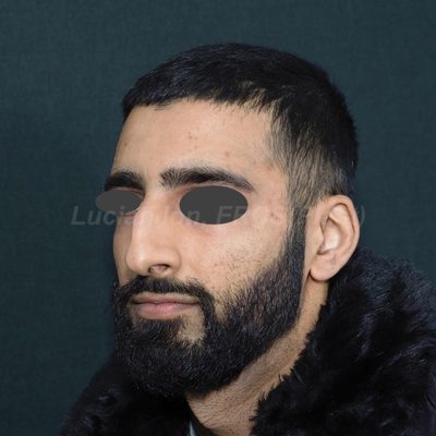 Before deviated nose (crooked nose), case 4, oblique view