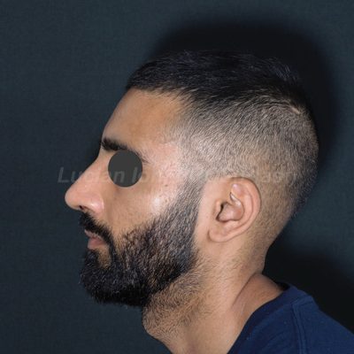 After deviated nose (crooked nose), case 4, profile view