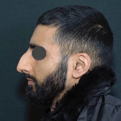 Before deviated nose (crooked nose), case 4, profile view
