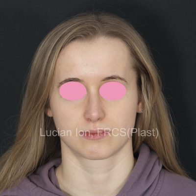 After deviated nose (crooked nose), case 5, front view