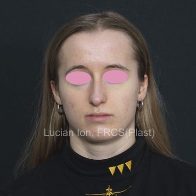 Before deviated nose (crooked nose), case 5, front view