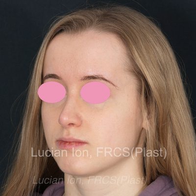 After deviated nose (crooked nose), case 5, oblique view
