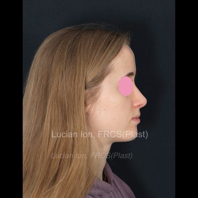 After deviated nose (crooked nose), case 5, profile view
