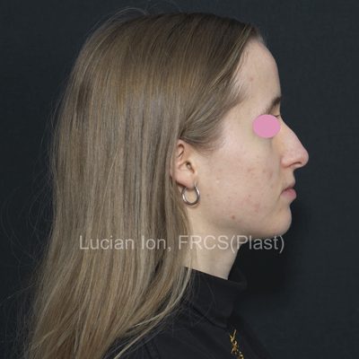 Before deviated nose (crooked nose), case 5, profile view