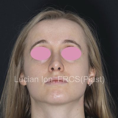 After deviated nose (crooked nose), case 5, base view view