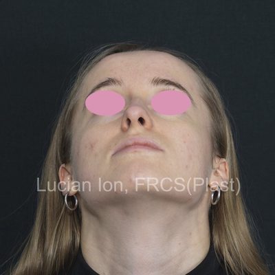 Before deviated nose (crooked nose), case 5, base view view