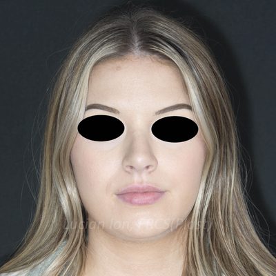 After deviated nose (crooked nose), case 6, front view