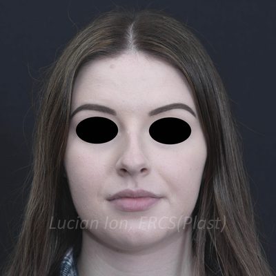 Before deviated nose (crooked nose), case 6, front view