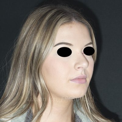 After deviated nose (crooked nose), case 6, oblique view