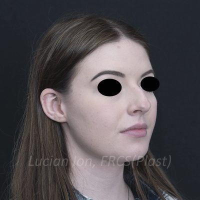 Before deviated nose (crooked nose), case 6, oblique view