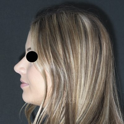After deviated nose (crooked nose), case 6, profile view