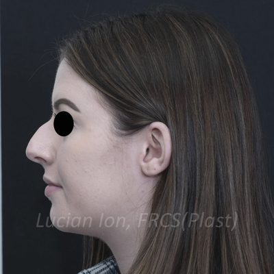 Before deviated nose (crooked nose), case 6, profile view