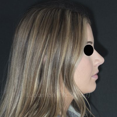 After deviated nose (crooked nose), case 6, profile view