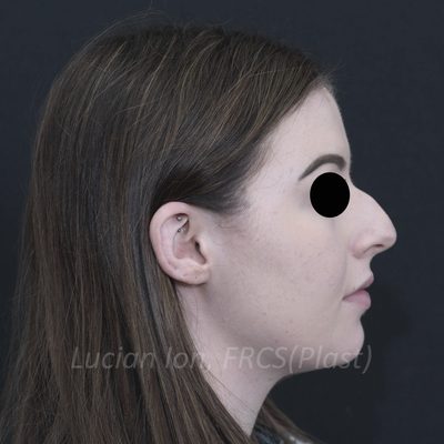 Before deviated nose (crooked nose), case 6, profile view