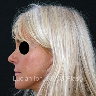 After reduction rhinoplasty, case 1, profile view