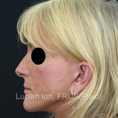 Before reduction rhinoplasty, case 1, profile view