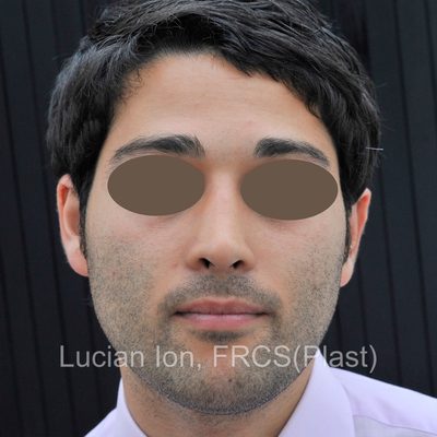 After reduction rhinoplasty, case 2, front view