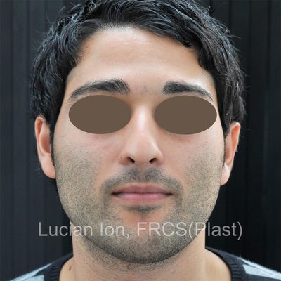 Before reduction rhinoplasty, case 2, front view