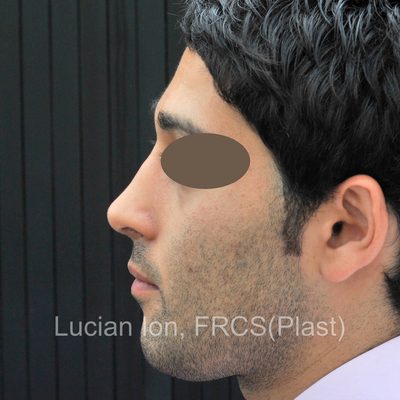 After reduction rhinoplasty, case 2, profile view